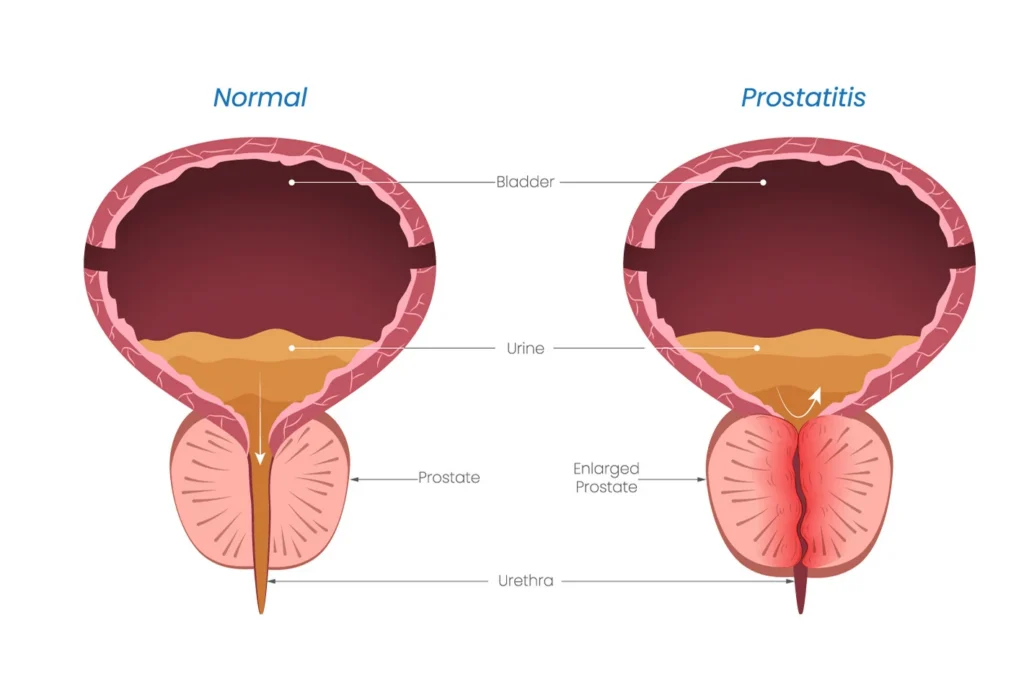Bph Illustration