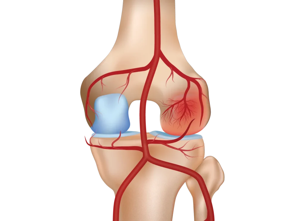 Knee Pain Gae Treatment Before