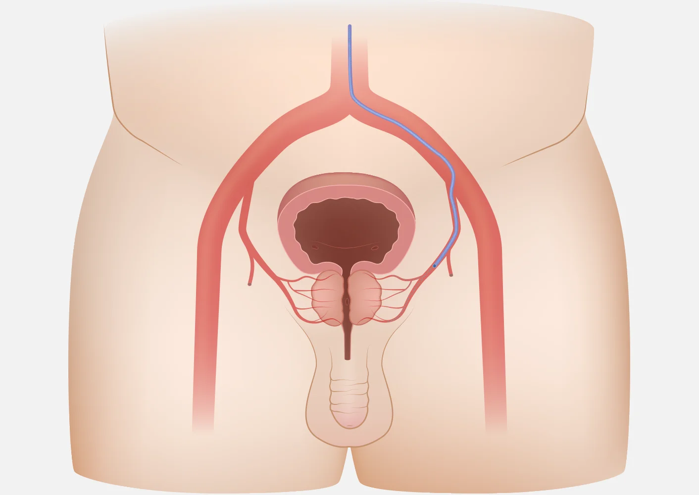 BPH Illustration After PAE Treatment
