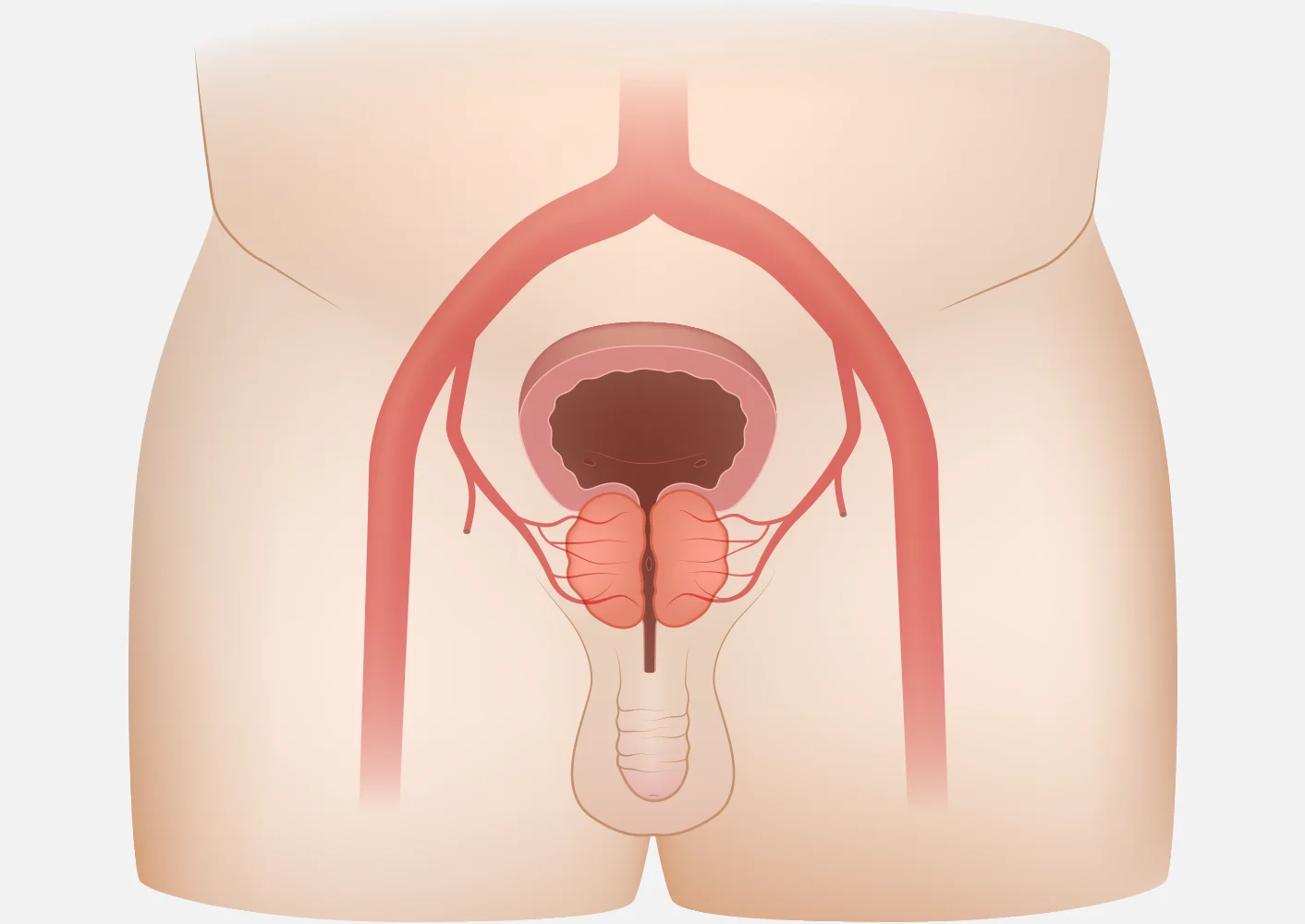 BPH Illustration Before
